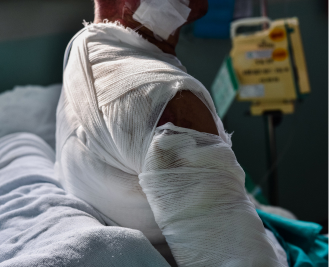 burn injury attorney near me